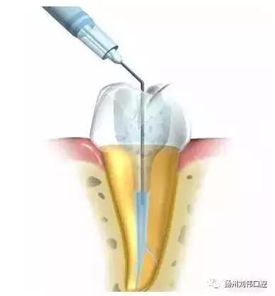 广东省口腔医院根管治疗，专业治疗，守护口腔健康